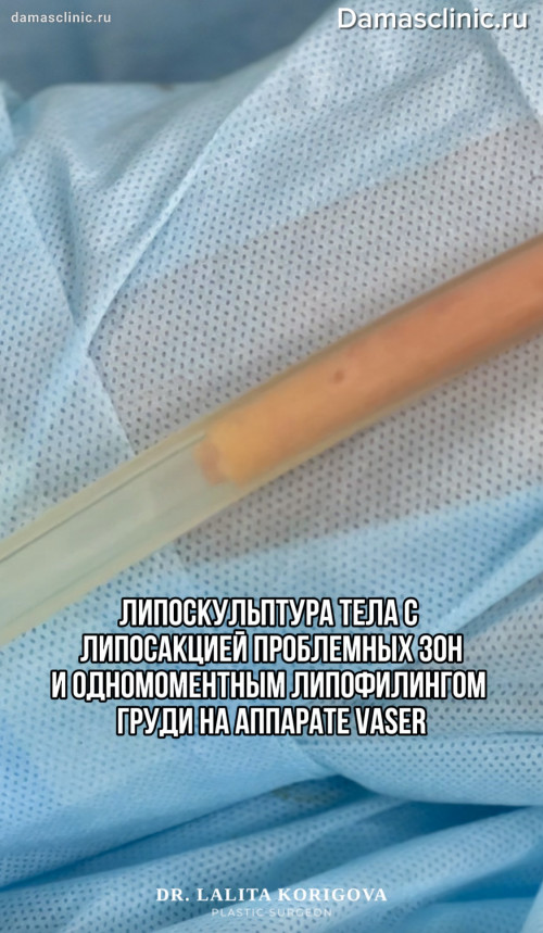 Липоскульптура тела с липосакцией проблемных зон и одномоментным липофилингом груди на аппарате VASER с видео- и фото-результатами