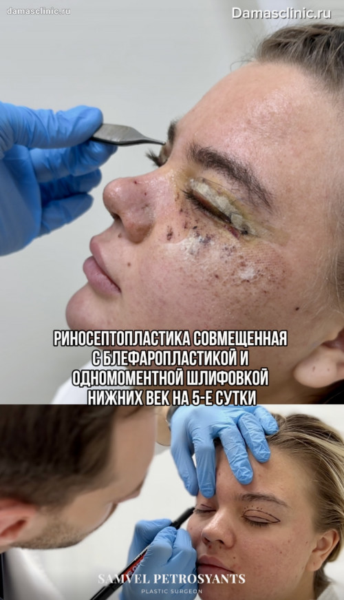 Риносептопластика, совмещенная с блефаропластикой и одномоментной шлифовкой нижних век, на 5-е сутки с видео