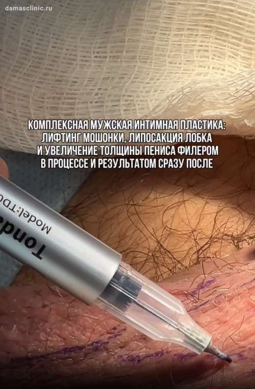 Липофилинг ствола полового члена и увеличение филером головки полового члена: до и сразу после с фото-результатами