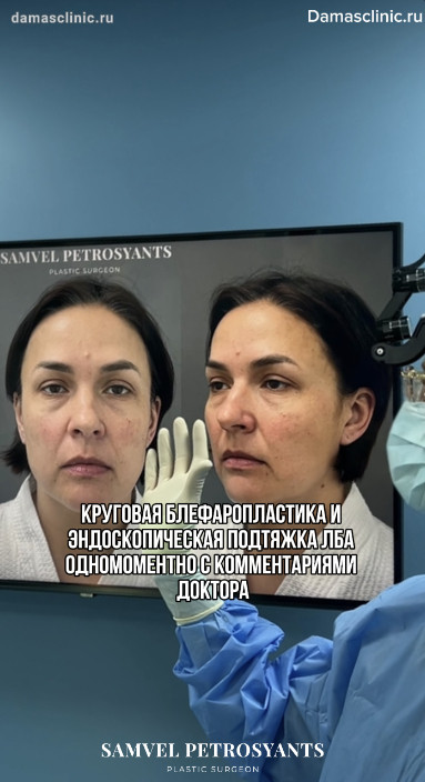 Круговая блефаропластика и эндоскопическая подтяжка лба одномоментно с комментариями доктора. Фото-результаты
