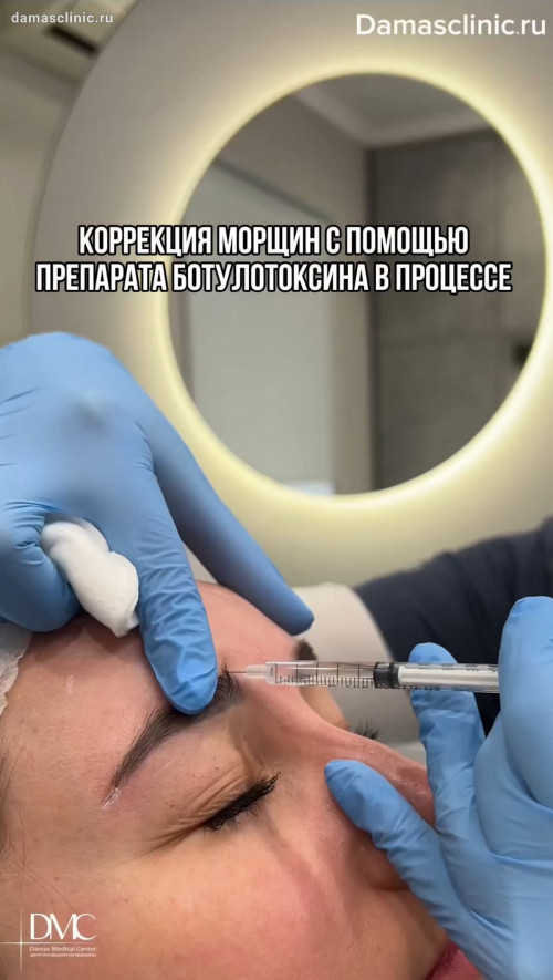 Процедура коррекции морщин препаратом ботулотоксина в процессе и с фото-результатами