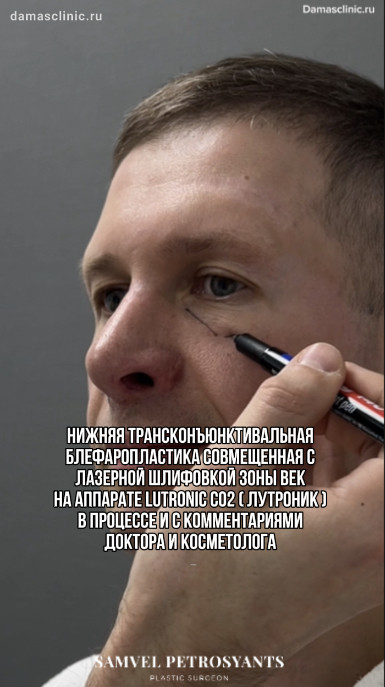 Мужская нижняя трансконъюнктивальная блефаропластика, совмещенная с лазерной шлифовкой зоны век на аппарате LUTRONIC CO2 (Лутроник), в процессе и с комментариями доктора и косметолога