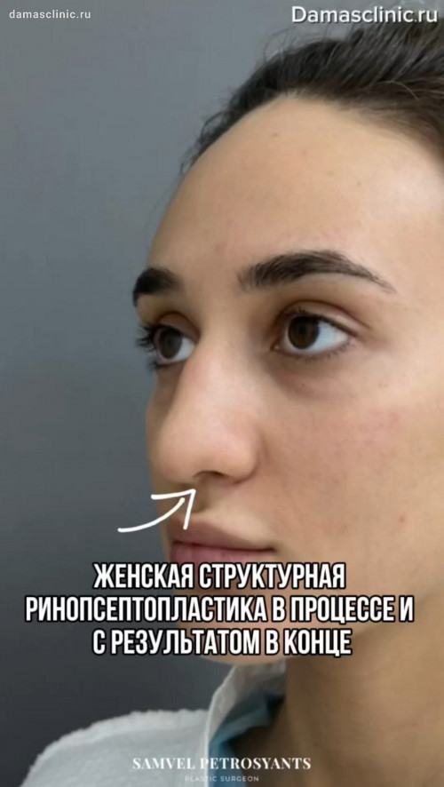 Женская структурная риносептопластика в процессе, с результатом в конце и снятие гипса на 7-е сутки с видео