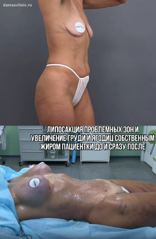 Увеличение груди и ягодиц одномоментно с липосакцией на аппарате Vaser / Вайзер в процессе и с результатами сразу после
