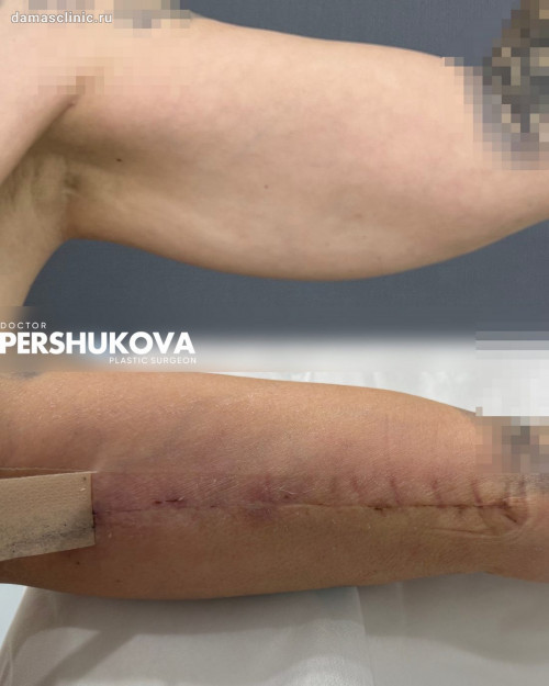 Брахиопластика: как выглядят швы после и фото финальных результатов