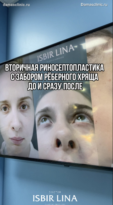 Вторичная риносептопластика с забором реберного хряща: в процессе, до и сразу после. Первая операция проводилась у сторонних специалистов