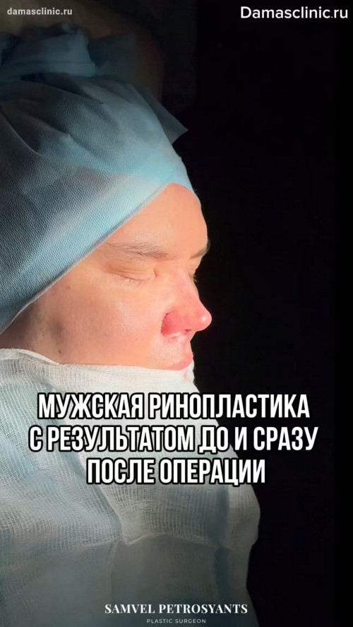 Мужская ринопластика с результатом до и сразу после операции (с видео)