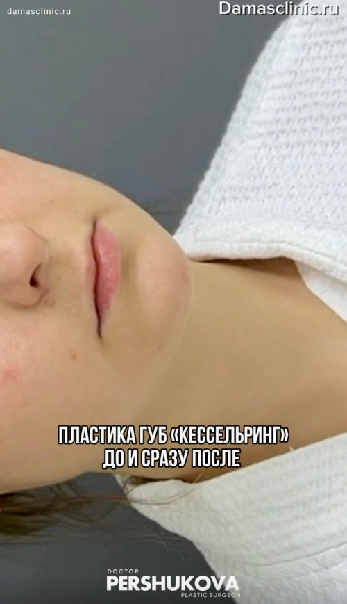 Хейлопластика «Кессельринг»: до и сразу после операции в видео