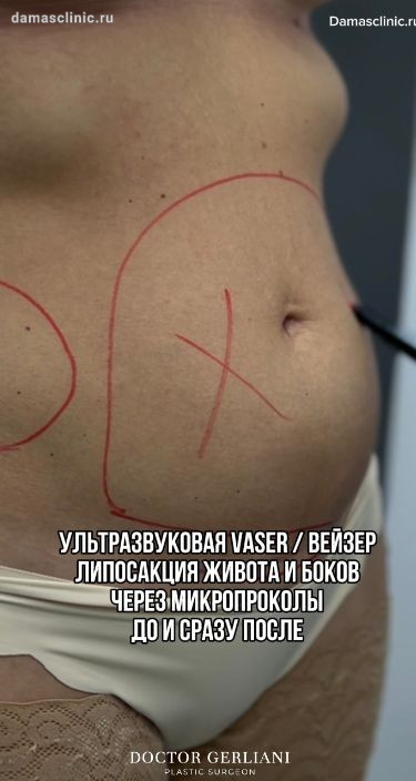 Ультразвуковая VASER / ВЕЙЗЕР липосакция живота и боков через микропроколы: в процессе с результатами сразу после