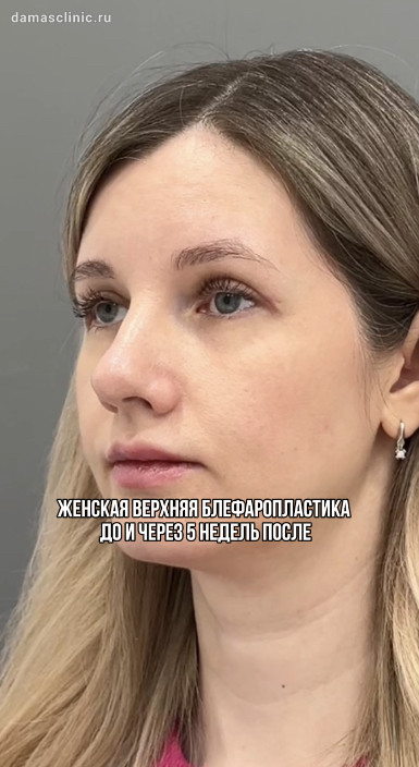 Женская верхняя блефаропластика: до и через 5 недель после в видео-результате