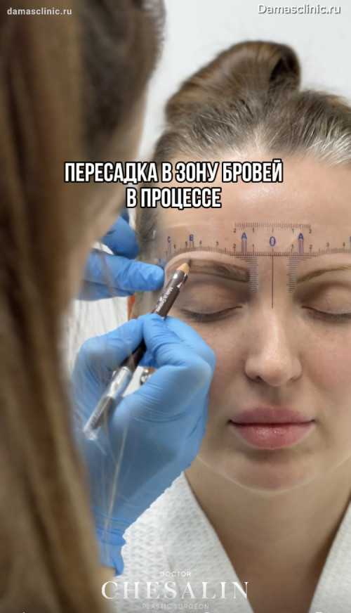 Пересадка в зону бровей: в процессе и с фото-результатами