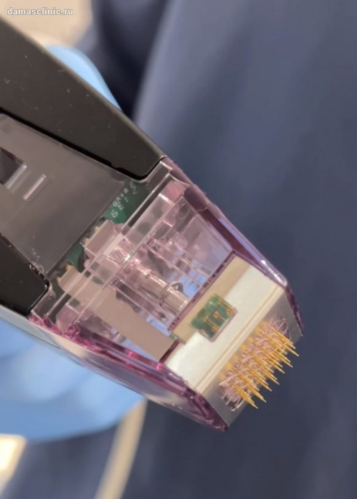 Чем отличается RF-шлифовка на аппарате MORPHEUS-8 от лазерной шлифовки. Показания и эффективность