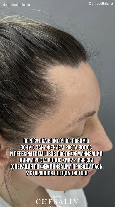 Пересадка в височно-лобную зону с занижением роста волос и перекрытием швов после феминизации линии роста волос хирургически (операция по феминизации проводилась у сторонних специалистов) с видео-результатом