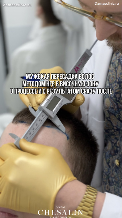 Трансплантация волос для мужчины методом HFE в височную зону в процессе и с результатом сразу после с фото