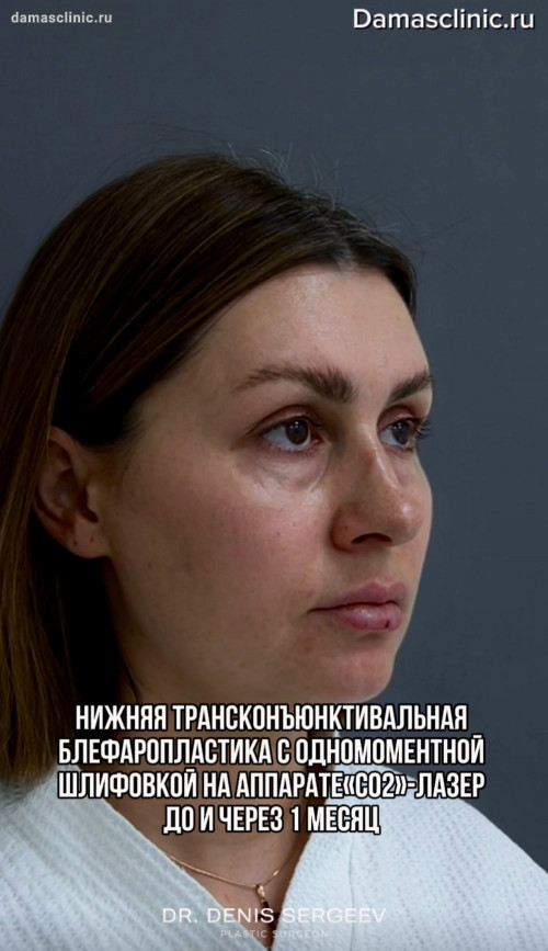 Нижняя трансконъюнктивальная блефаропластика с одномоментной шлифовкой на аппарате «CO2»-лазер: до через 1 месяц с фото-результатом