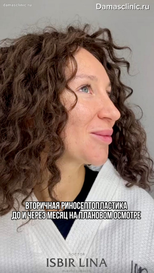 Вторичная риносептопластика до и через месяц на плановом осмотре с отзывом пациентки