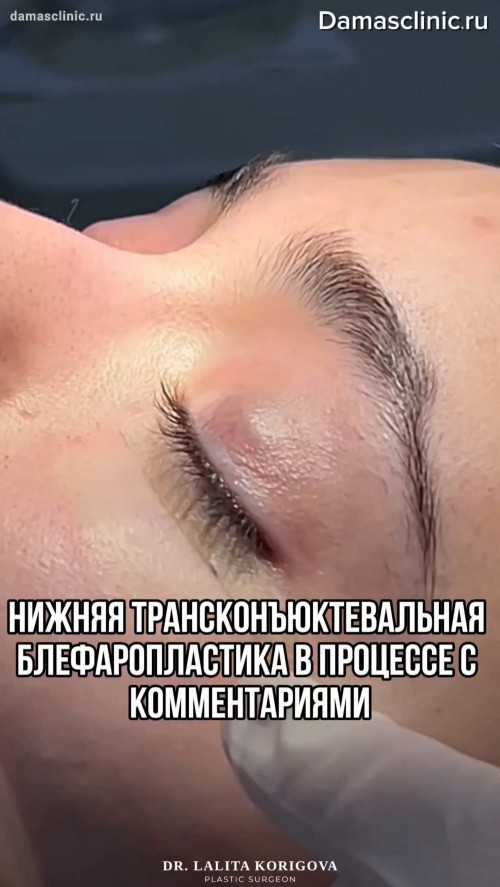 Нижняя трансконъюнктивальная блефаропластика с комментариями. Видео процесса