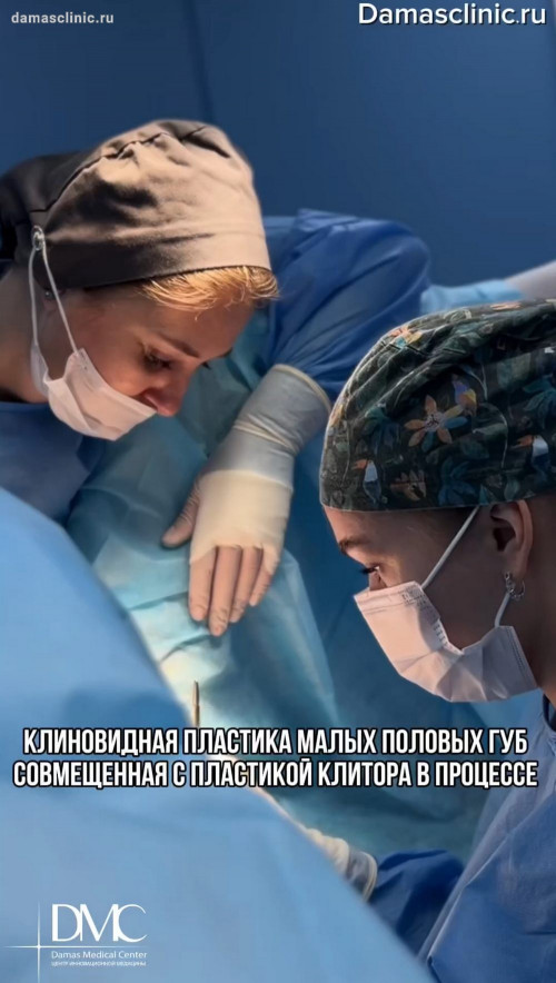 Клиновидная пластика малых половых губ, совмещенная с пластикой клитора, в процессе