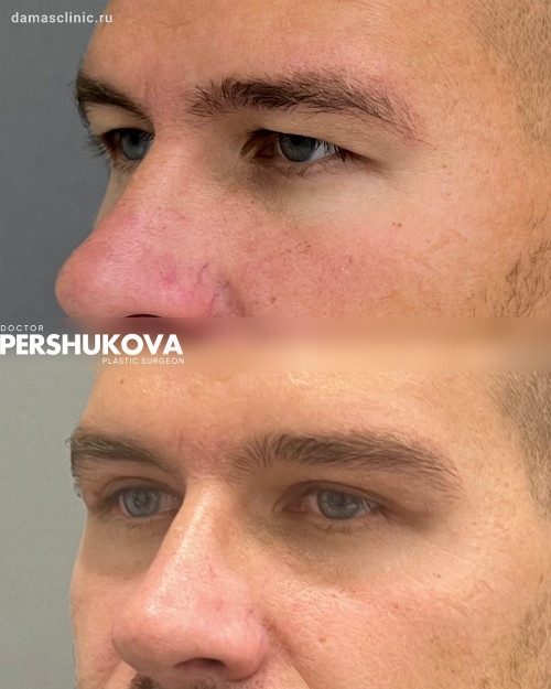 Мужская блефаропластика через 7 дней, сразу после снятия швов с фото-результатом от Анны Петровны Першуковой