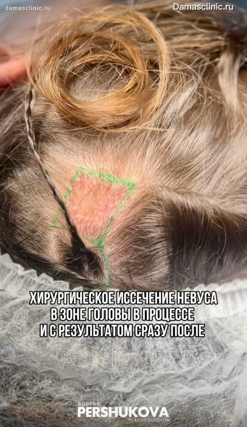 Хирургическое удаление невуса в зоне головы в процессе и с результатом после. Фото и видео