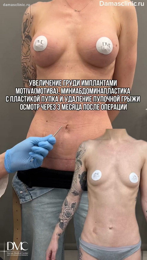 Увеличение груди имплантами MOTIVA (МОТИВА) через 3 месяца после операции с фото-результатами