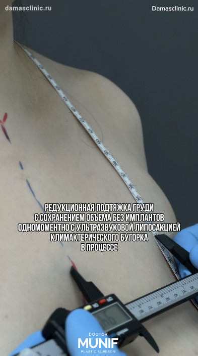 Редукционная подтяжка груди с сохранением объема без имплантов одномоментно с ультразвуковой липосакцией климактерического бугорка в процессе