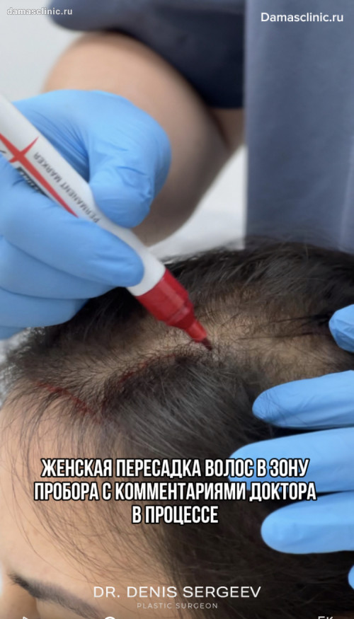Женская пересадка волос в зону пробора с комментариями доктора в процессе (с видео)