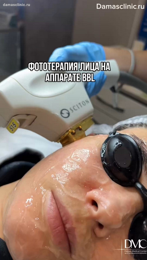 Фототерапия лица на аппарате BBL / Би Би Эль с видео