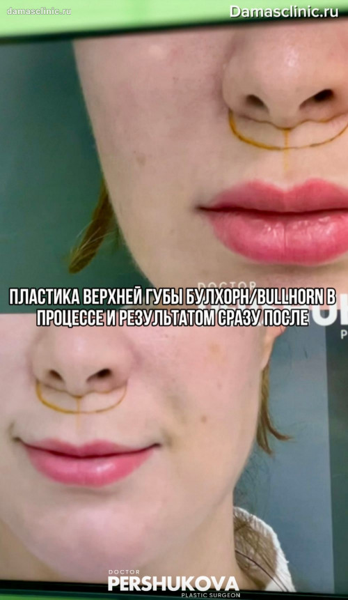 Хейлопластика БУЛХОРН / BULLHORN: в процессе, с фото-результатом после