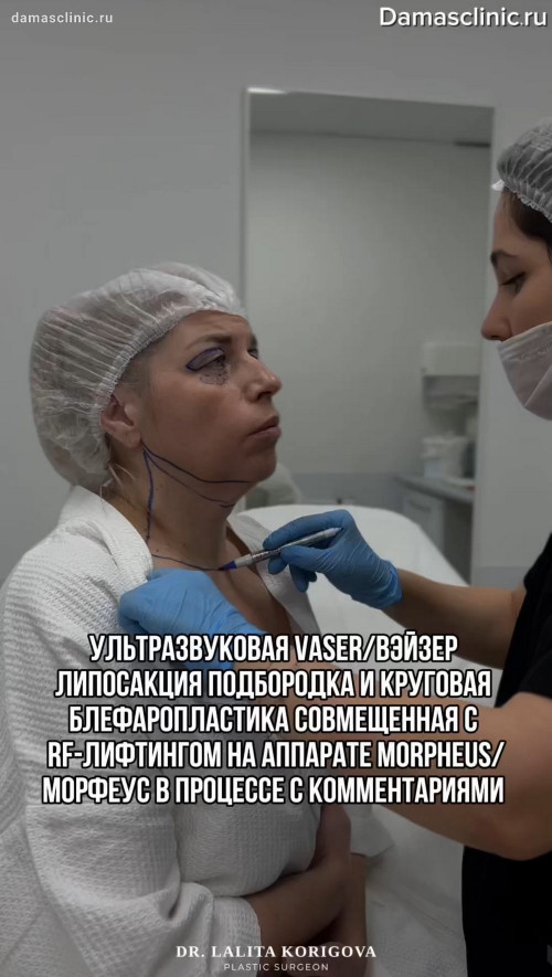 Ультразвуковая VASER / ВЭЙЗЕР липосакция подбородка и круговая блефаропластика, совмещенные с RF-лифтингом на аппарате MORPHEUS / МОРФЕУС: в процессе с комментариями
