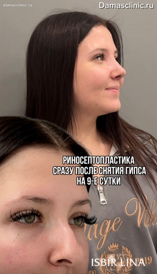 Ринопластика: как выглядит нос на 9-е сутки после операции, сразу после снятия гипса