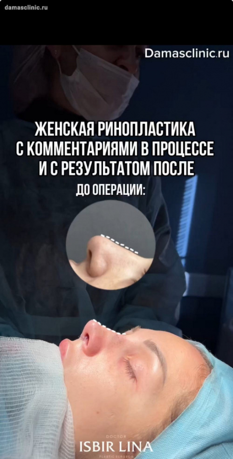 Женская ринопластика с комментариями в процессе и с результатом после (с видео)