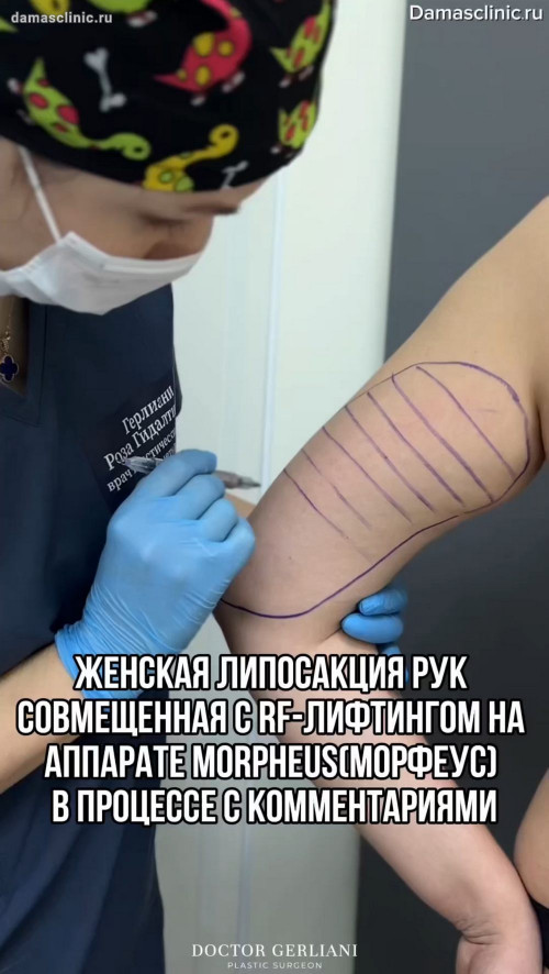 Женская липосакция рук, совмещенная с RF-лифтингом на аппарате MORPHEUS (МОРФЕУС): в процессе с комментариями (в видео)