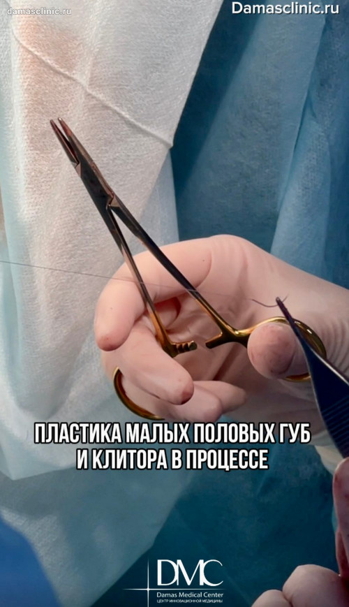 Клиновидная пластика малых половых губ и пластика клитора: до и через 4 месяца с фото-результатами