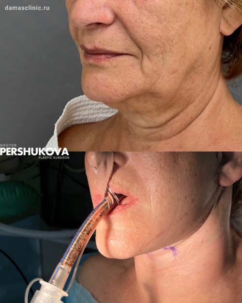 Комплексная пластика лица: фейслифтинг с платизмопластикой, круговая блефаропластика, эндоскопическая подтяжка висков: с комментариями в процессе и результатом сразу после