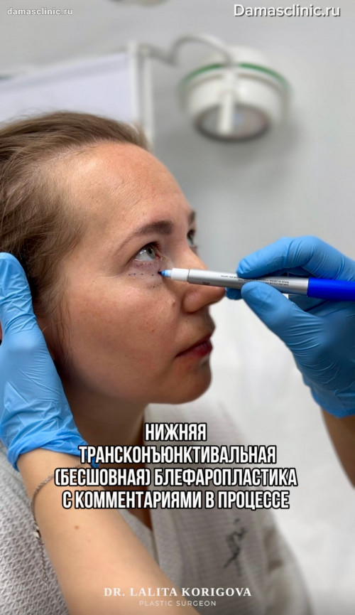 Нижняя трансконъюнктивальная блефаропластика в процессе с комментариями в видео