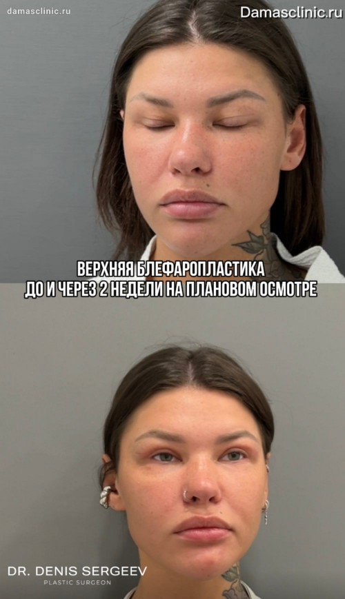 Верхняя блефаропластика: до и через 2 недели на плановом осмотре с видео-результатом