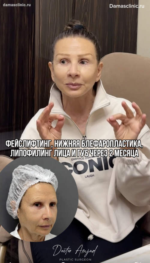Пациентке 70 лет. Фейслифтинг, нижняя блефаропластика, липофилинг лица и губ с фото и видео от доктора Амжада Аль-Юсеф
