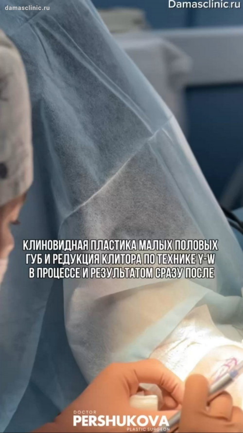 Клиновидная пластика малых половых губ и редукция клитора по технике Y-W в процессе и с результатом сразу после в видео от Анны Петровны Першуковой