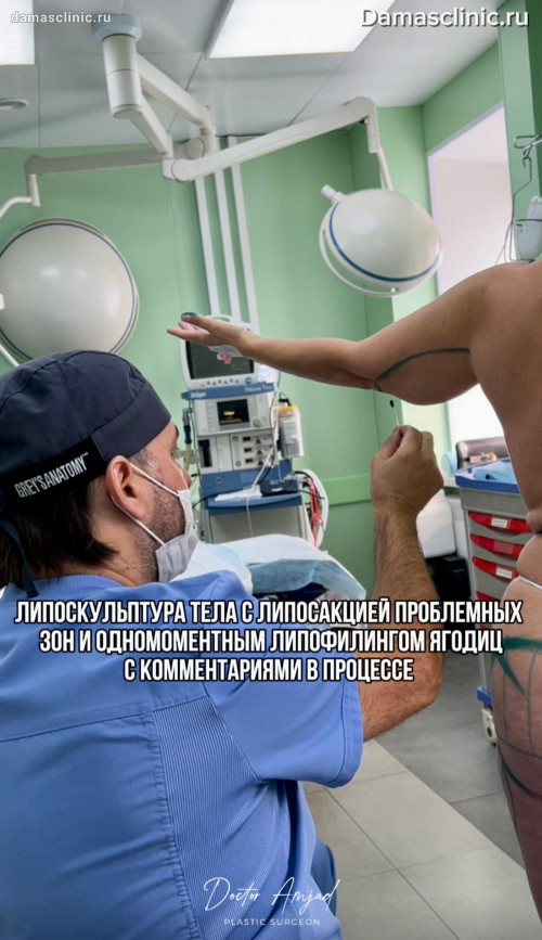 Липоскульптура тела с липосакцией проблемных зон и одномоментным липофилингом ягодиц с комментариями в процессе и с фото-результатами