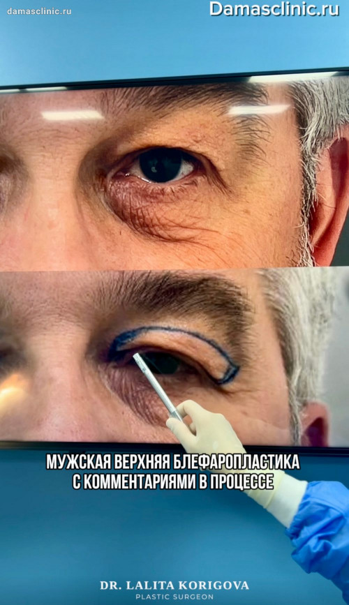 Мужская верхняя блефаропластика с комментариями в процессе. Фото результатов