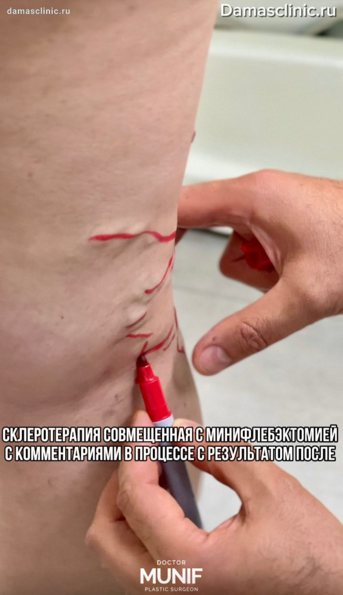 Склеротерапия, совмещенная с минифлебэктомией, с комментариями в процессе и результатом после