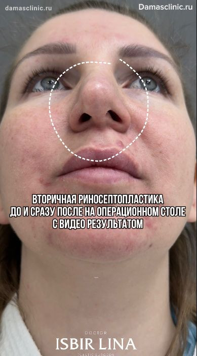 Вторичная риносептопластика: до и сразу после на операционном столе (видео-результаты)