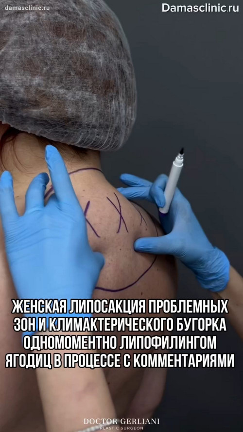 Женская липосакция проблемных зон и климактерического бугорка одномоментно с липофилингом ягодиц (в процессе, с комментариями)