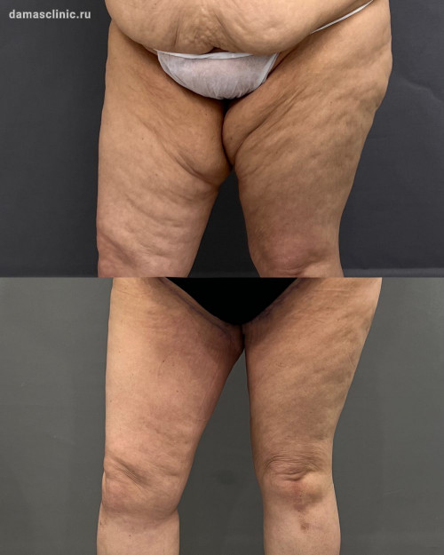 Ультразвуковая VASER / ВАЙЗЕР липосакция бедер + феморопластика (подтяжка бедер): до и через 2 месяца после на плановом осмотре (фото-результат)