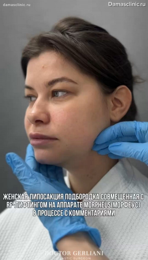 Женская липосакция подбородка, совмещенная с RF-лифтингом на аппарате MORPHEUS / МОРФЕУС: в процессе с комментариями