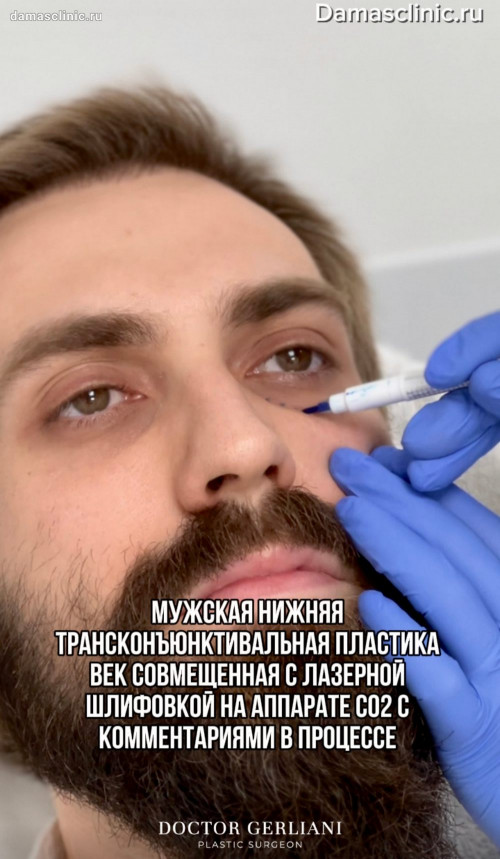 Мужская нижняя трансконъюнктивальная пластика век, совмещенная с лазерной шлифовкой на аппарате СО2: с комментариями в процессе