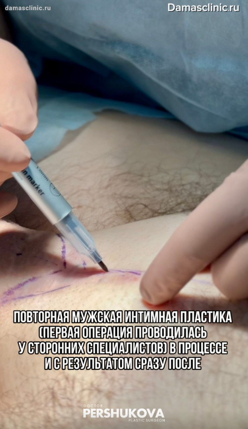 Повторная мужская интимная пластика (первая операция проводилась у сторонних специалистов) в процессе и с результатом сразу после