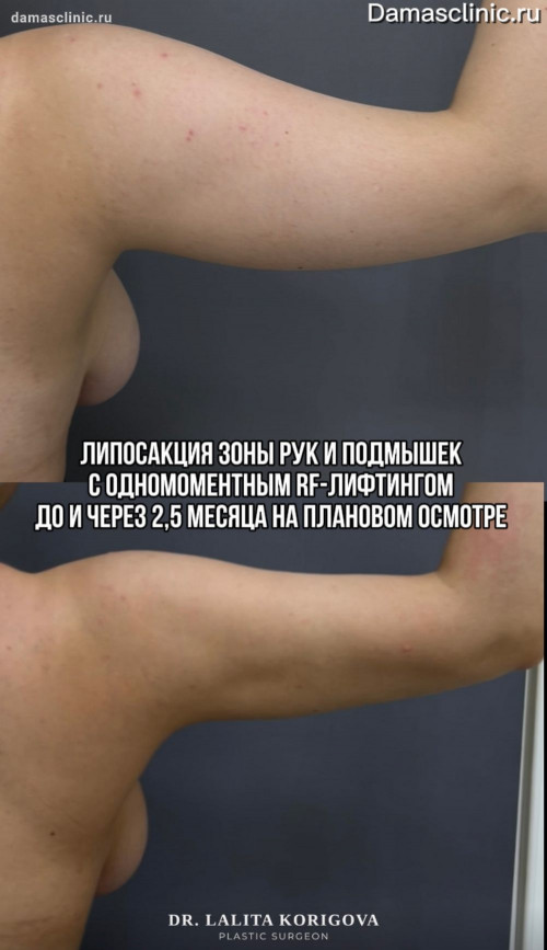 Липосакция зоны рук и подмышек с одномоментным RF-лифтингом на аппарате MORPHEUS / МОРФЕУС 8: до и через 2,5 месяца с фото- и видео-результатом