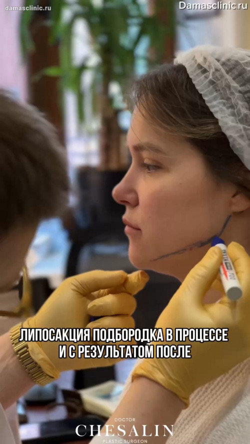 Липосакция подбородка: в процессе и с фото-результатом сразу после